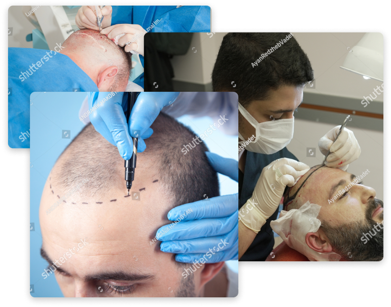 hair transplant