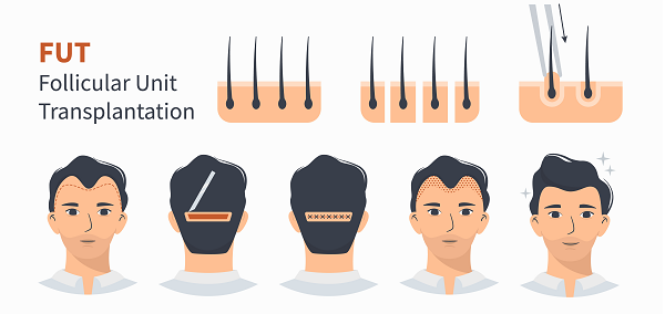 FUE and FUT Methods