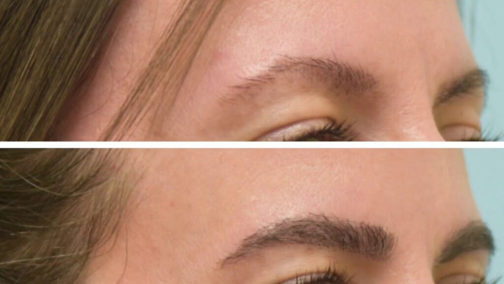 Eyebrow Transplant in Melbourne