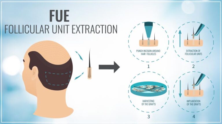 hair transplant fue technique