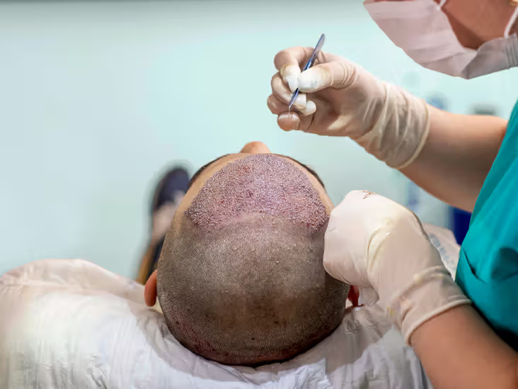 FUE Hair Transplant Melbourne