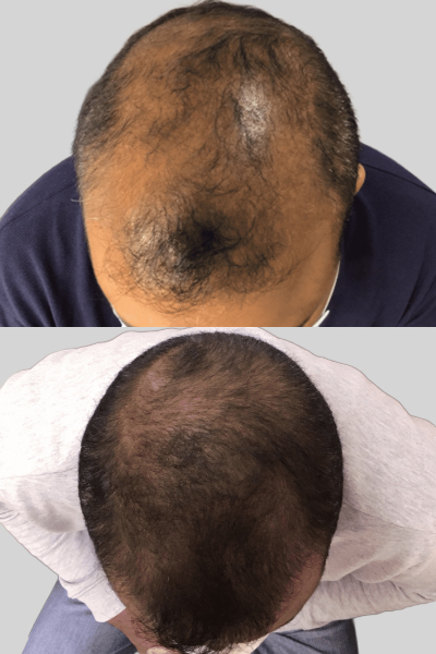 Top 7 Early Signs of Male Pattern Baldness