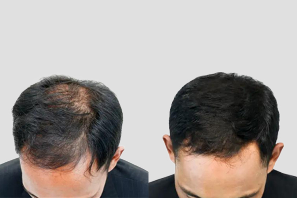 Hair Transplant Recovery Timeline